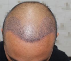 -大麦微针植发全国连锁