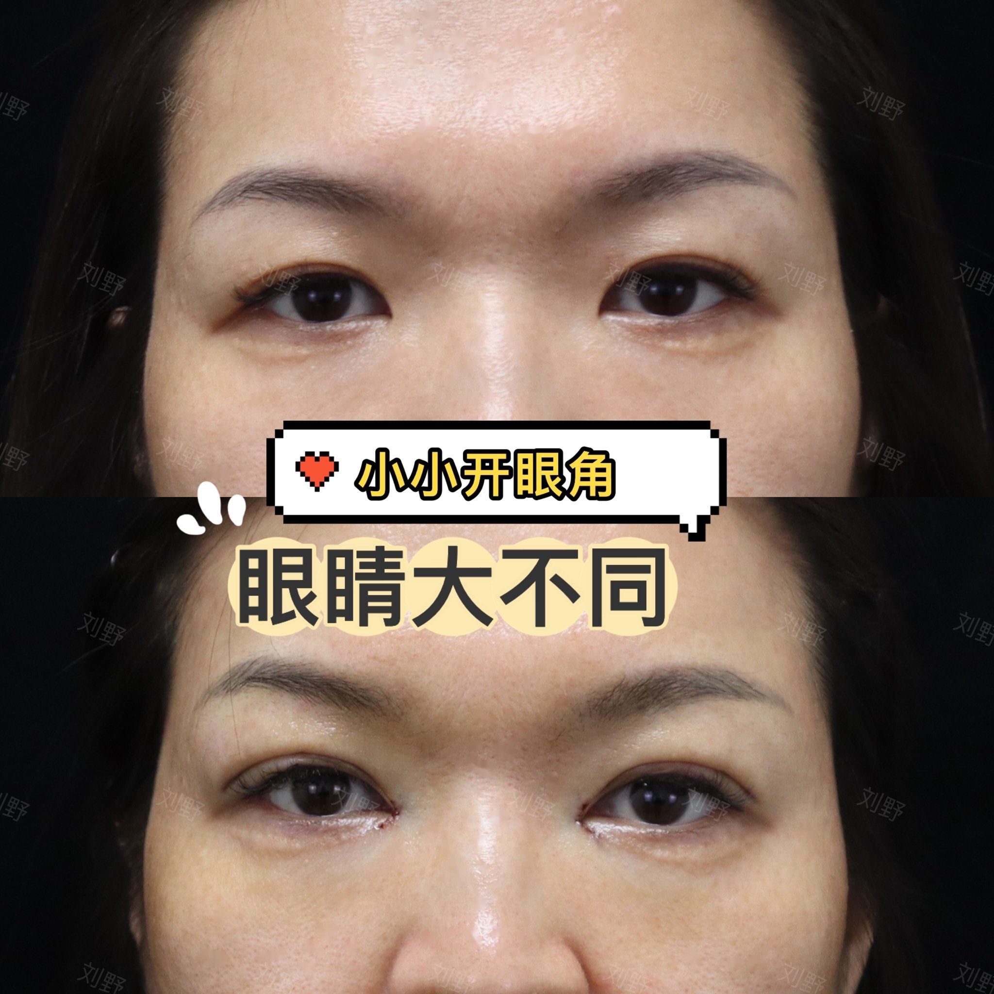 小小开眼角,眼睛大不同!