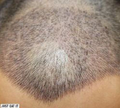 -大麦微针植发丨全国连锁