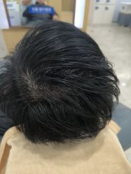 -大麦微针植发丨全国连锁
