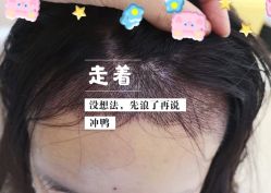 -大麦微针植发全国连锁