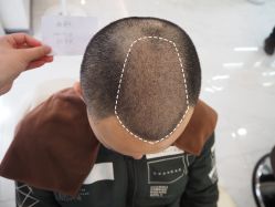 -大麦微针植发丨全国连锁