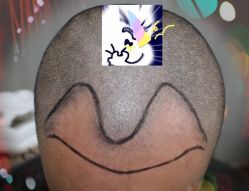 -大麦微针植发全国连锁