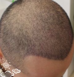 -大麦微针植发丨全国连锁