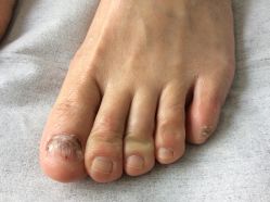 -德哥灰指甲脚气甲沟炎跖疣护理