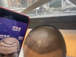 -碧莲盛·不剃发植发