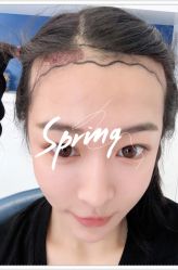 点击看大图 -大麦微针植发全国连锁