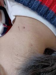 -痣清宫祛斑祛痣连锁店