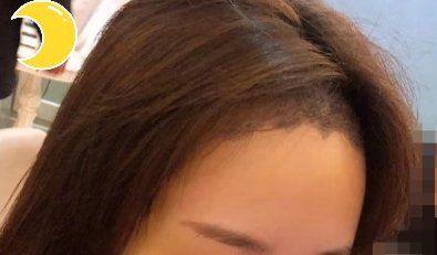 -大麦微针植发丨全国连锁