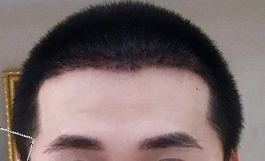 -大麦微针植发丨全国连锁