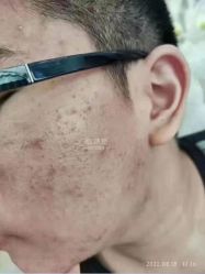 -蕾特恩专业祛痘国际连锁