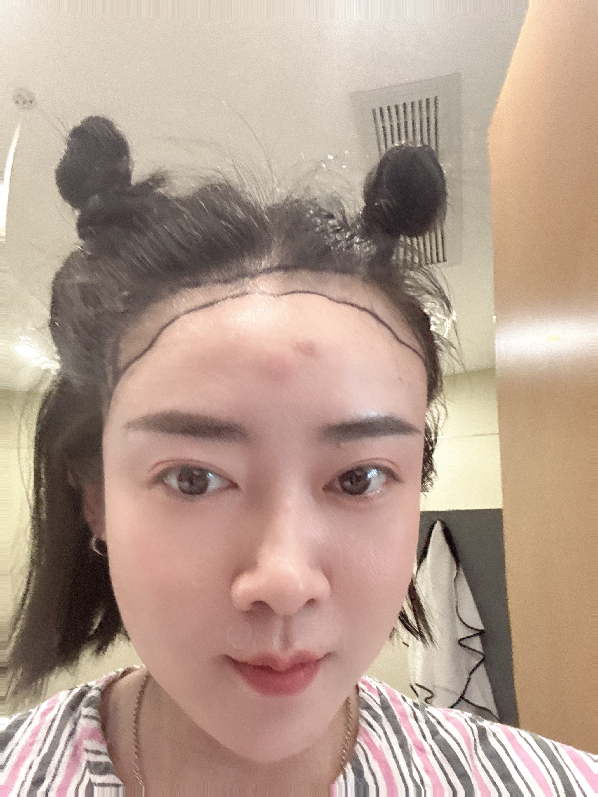 植发后会不会掉(植发后会不会脱落)