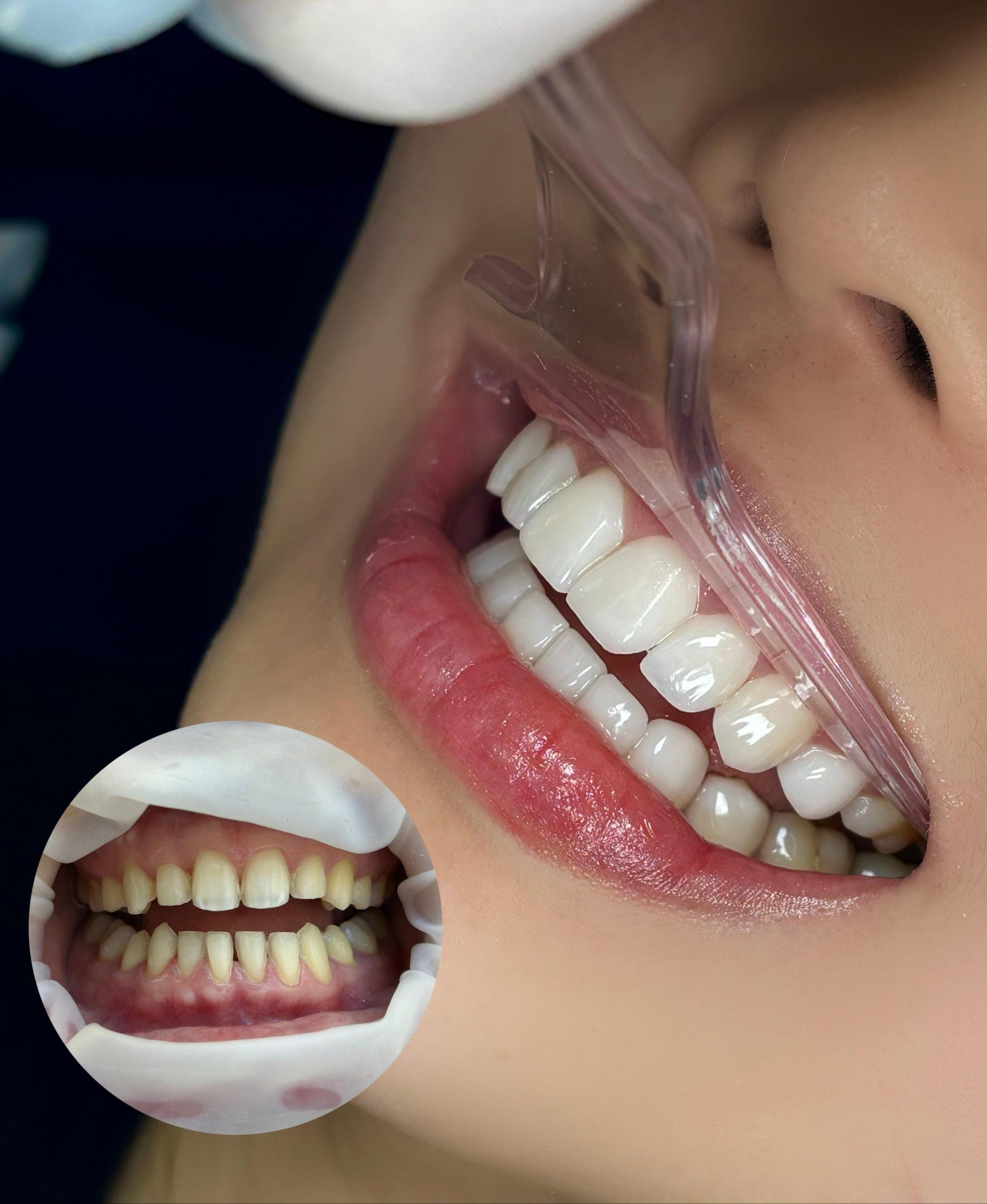 美白牙齿#口腔医院#矫正牙齿#给你们看看我的生活#幸福日常分享~#洗牙