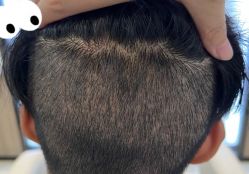 -大麦微针植发全国连锁