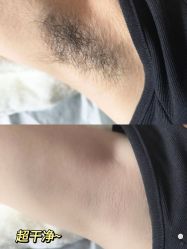 -薇兰专业脱毛连锁机构