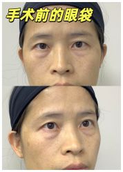 -广州健丽·去眼袋医疗美容机构