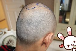 点击看大图 -大麦微针植发丨全国连锁