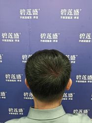 -碧莲盛·不剃发植发