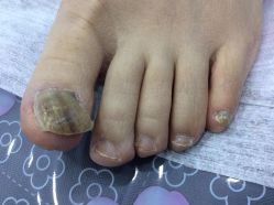 -德哥灰指甲脚气甲沟炎跖疣护理