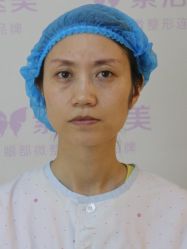 体验前-紫洁俪方（北京）医疗美容