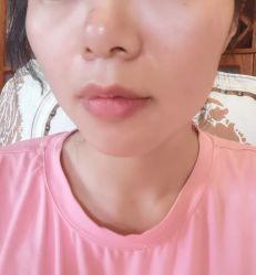 体验后-美莱医学美容医院