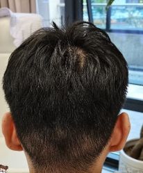 -大麦微针植发丨全国连锁