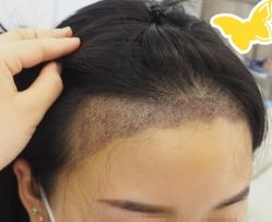 -大麦微针植发丨全国连锁