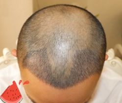 -大麦微针植发丨全国连锁