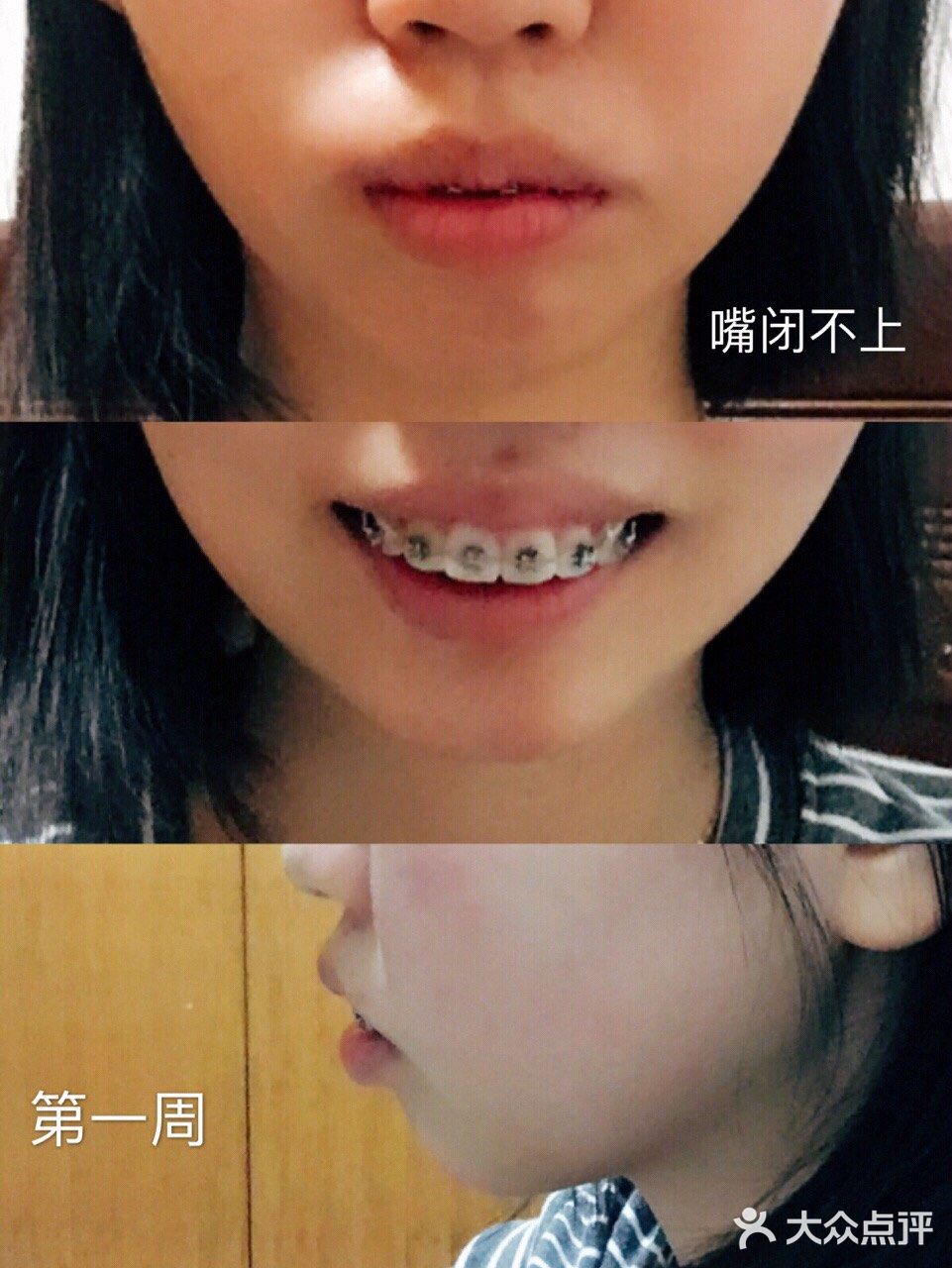 骨性深覆合金属自锁矫正案例 