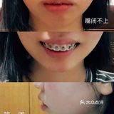 骨性深覆合金属自锁矫正案例 