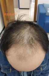 -大麦微针植发全国连锁