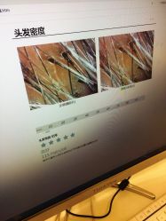 -碧莲盛·不剃发植发