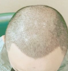 -大麦微针植发丨全国连锁