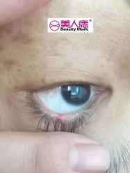 -美人痣全国连锁