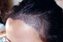 -大麦微针植发丨全国连锁