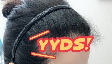 -大麦微针植发丨全国连锁