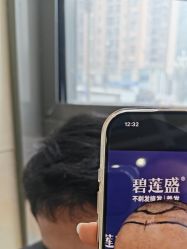 -碧莲盛·不剃发植发