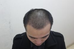 点击看大图 -大麦微针植发丨全国连锁