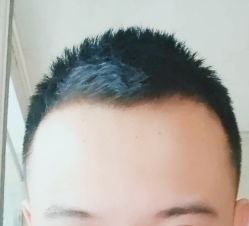 -大麦微针植发全国连锁
