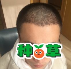 -大麦微针植发丨全国连锁