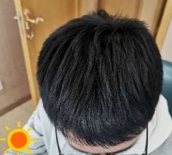 -大麦微针植发丨全国连锁