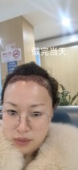 -大麦微针植发丨全国连锁