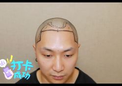 体验后-大麦微针植发全国连锁