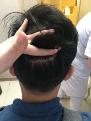 -大麦微针植发丨全国连锁