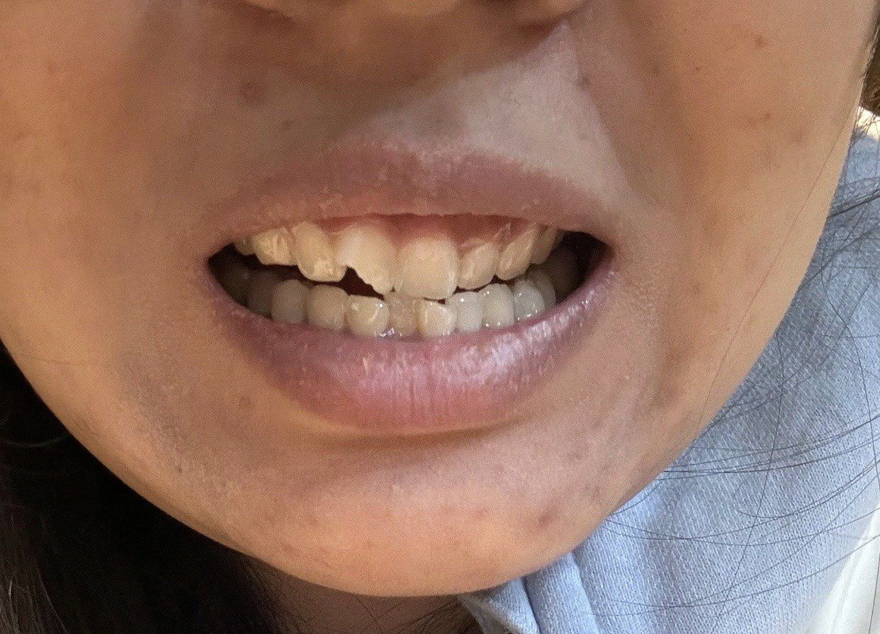 在一次不幸的磕碰中,我的门牙不幸受损,这不仅影响了我的饮食,更让我