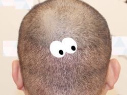 -大麦微针植发全国连锁