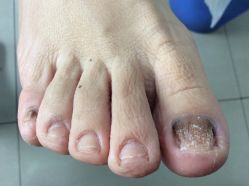 -德哥灰指甲脚气甲沟炎跖疣护理