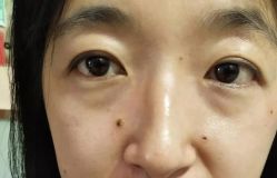 -北京美痣堂古方祛痣斑疣瘊