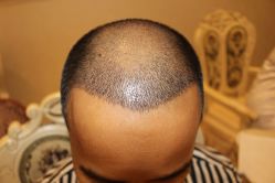 -大麦微针植发丨全国连锁