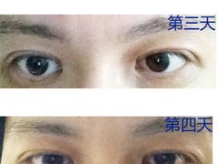 术后恢复情况-上海华安整形外科门诊部